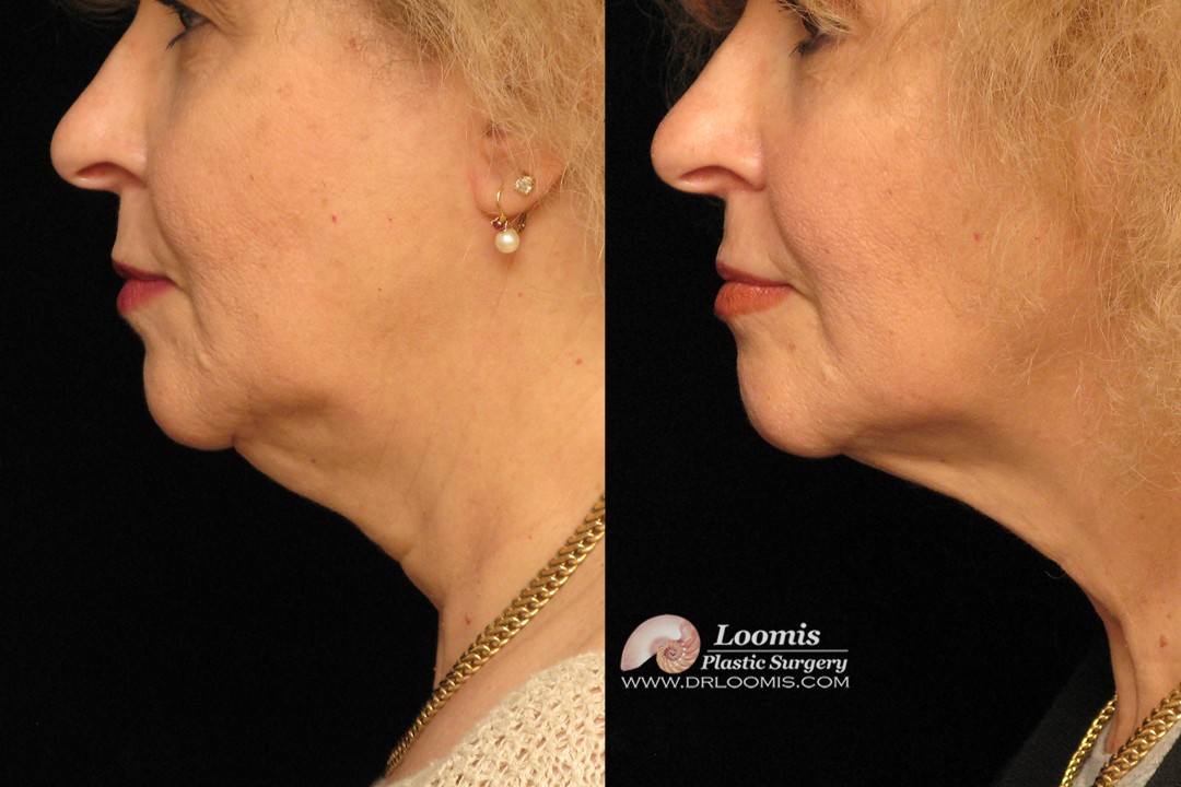 Kybella® treatment by Dr. Loomis (not a gurantee of results)