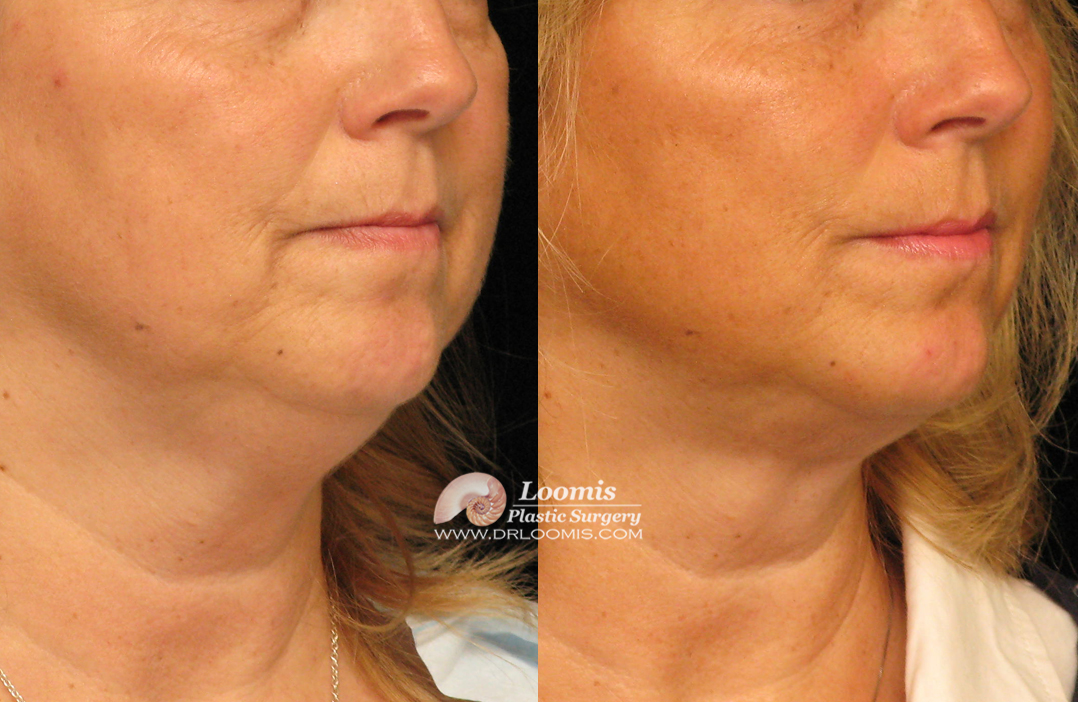 Kybella® treatment by Dr. Loomis (not a guarantee of results)