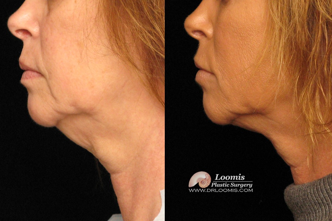 Neck fat treatment by Dr. Loomis (not a guarantee of results)