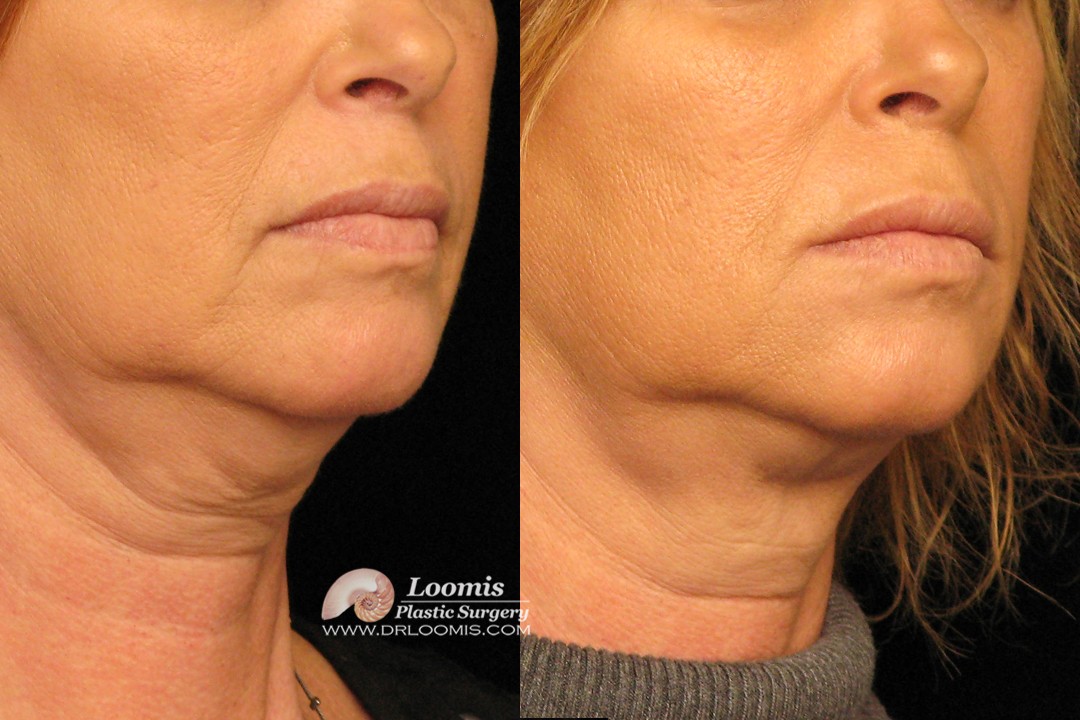 Kybella® treatment by Dr. Loomis: 2 sessions (not a guarantee of results)