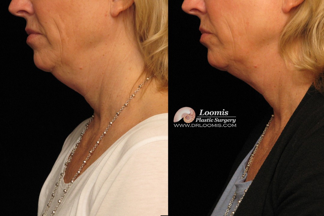 Kybella® by Dr. Loomis after first session. (not a guarantee of results.)