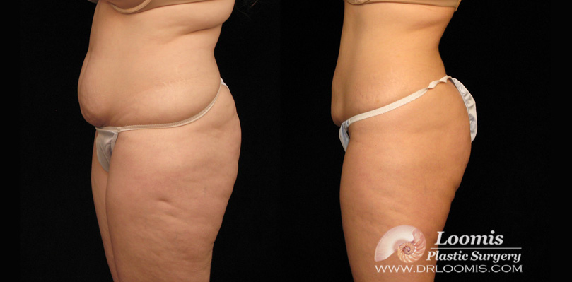 CoolSculpting before & after