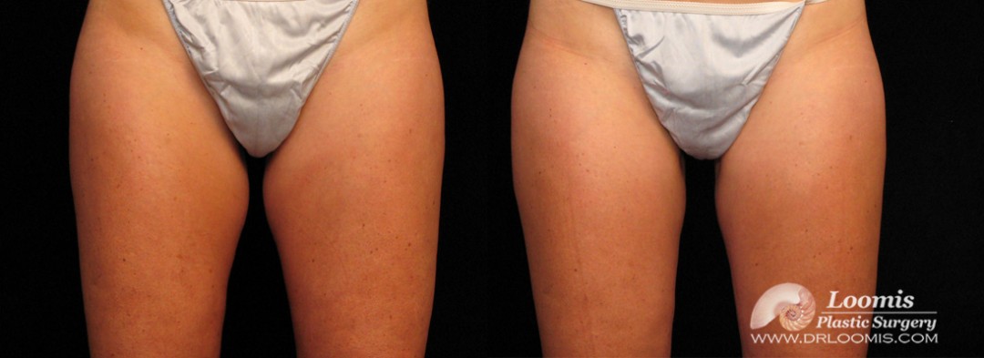 CoolSculpting inner thighs