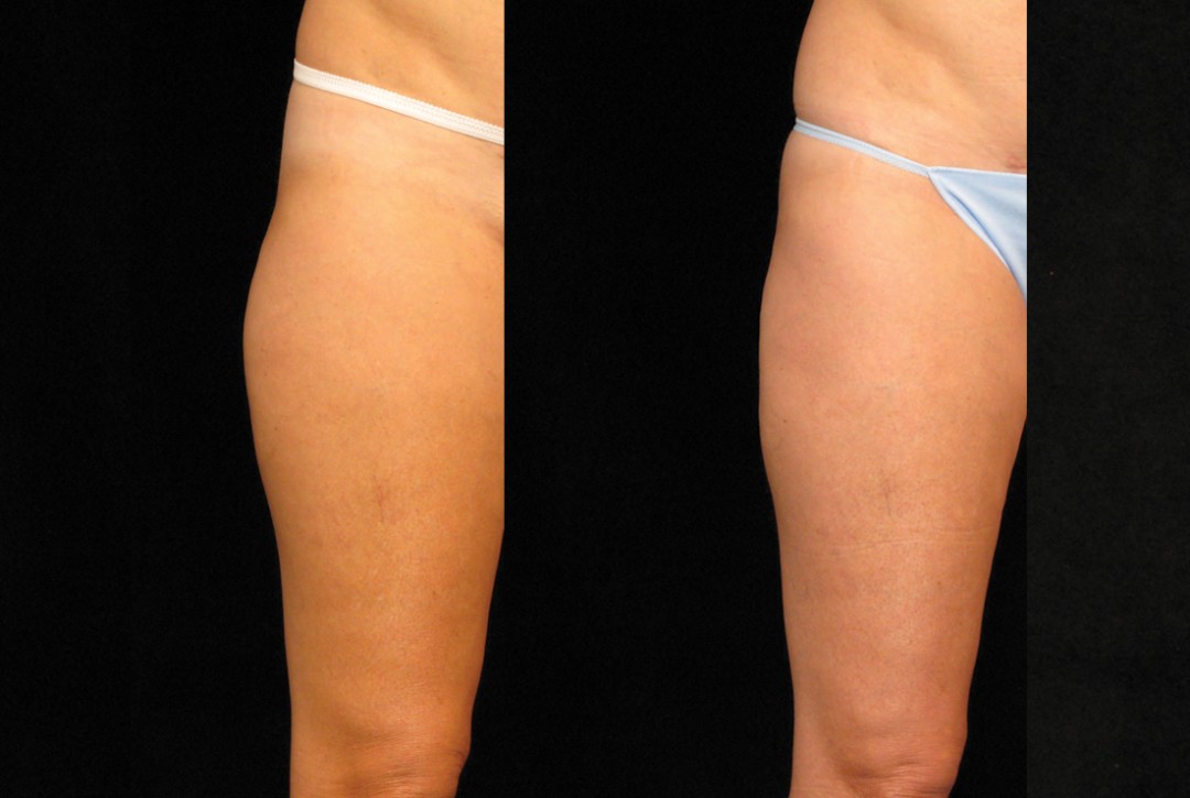 CoolSculpting outer thigh fat