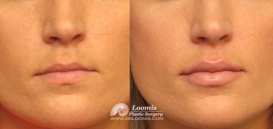 Lip enhancement with Juvederm® at Loomis Plastic Surgery (not a guarantee of results)