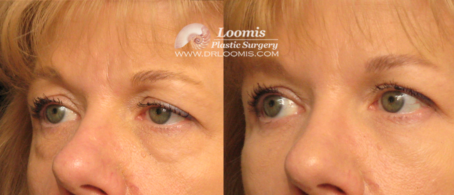 Liquid Eye Lift by Dr. Loomis (not a guarantee of results)
