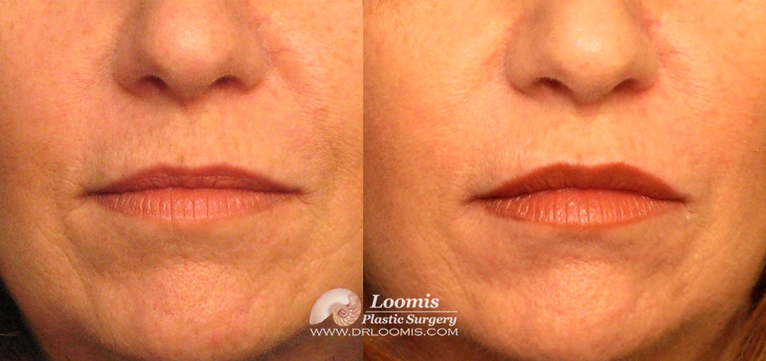 Volbella® for lip enlargement and correction of lines by Dr. Loomis (not a guarantee of results)