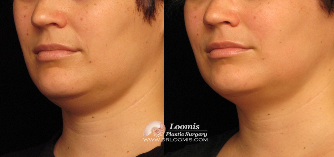 Kybella treatment by Dr. Loomis (not a guarantee of results)