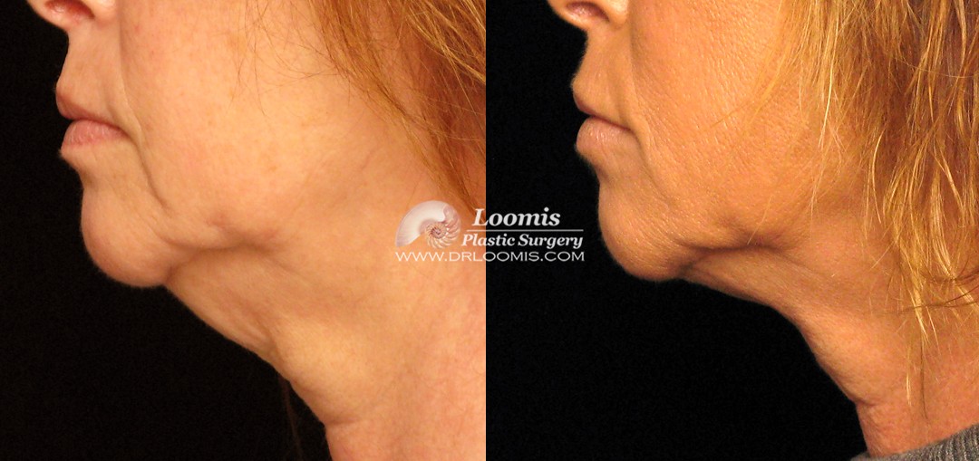 Kybella® treatment by Dr. Loomis (not a guarantee of results)